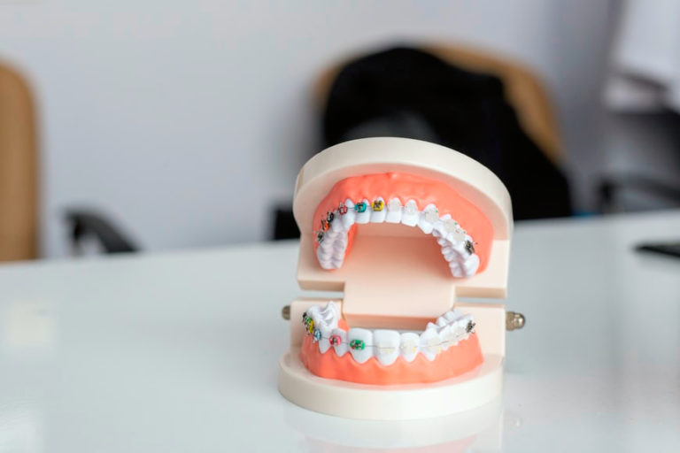 How Offering Designer Braces Can Increase Patient Starts
